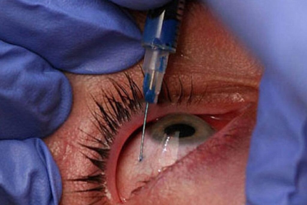 تزریق داخل چشمی